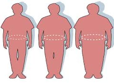 Obésité : que choisir entre anneau, by-pass et sleeve ?